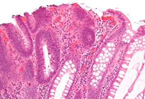 Rákvakcina és immunterápia együttes erejével semlegesíthetőek a rosszindulatú daganatok