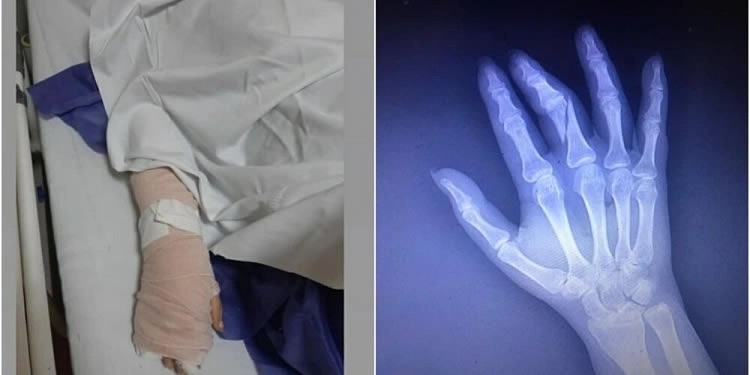 Megverték és eltörték az ujját egy újságírónak, mert nem volt hajlandó törölni a vakcina-interjúkat