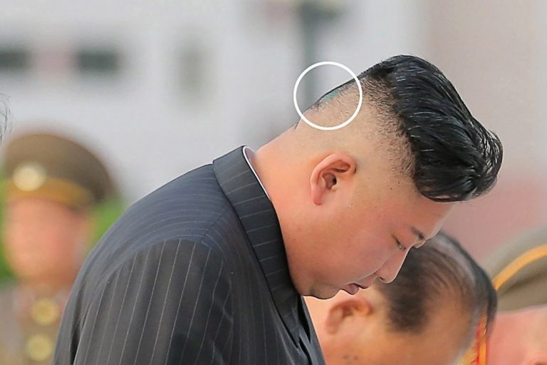 Kim Dzsongun tarkóján megjelent egy furcsa seb, elindultak a találgatások az egészsége kapcsán