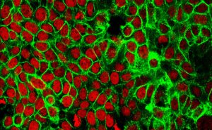 Innovatív módszerrel kezelhető az agresszív hasnyálmirigyrák