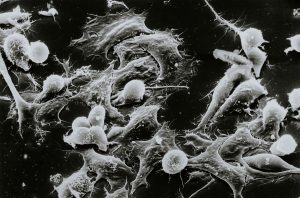 Fényérzékeny, nanoméretű bioanyaggal támadhatóak meg a rosszindulatú daganatok