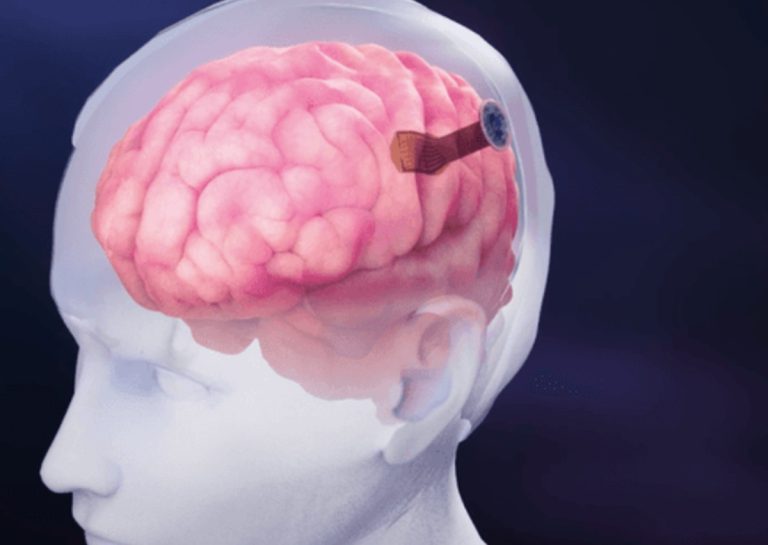 Világrekord: több mint 4 ezer elektródát ültetett egy emberi agyba a Neuralink riválisa