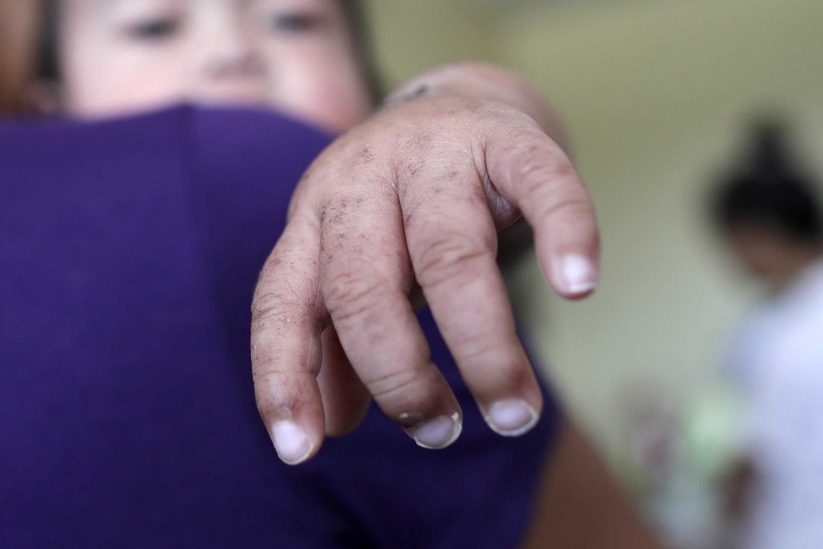 58 országban is aggasztó mértékben terjed a kanyaró 