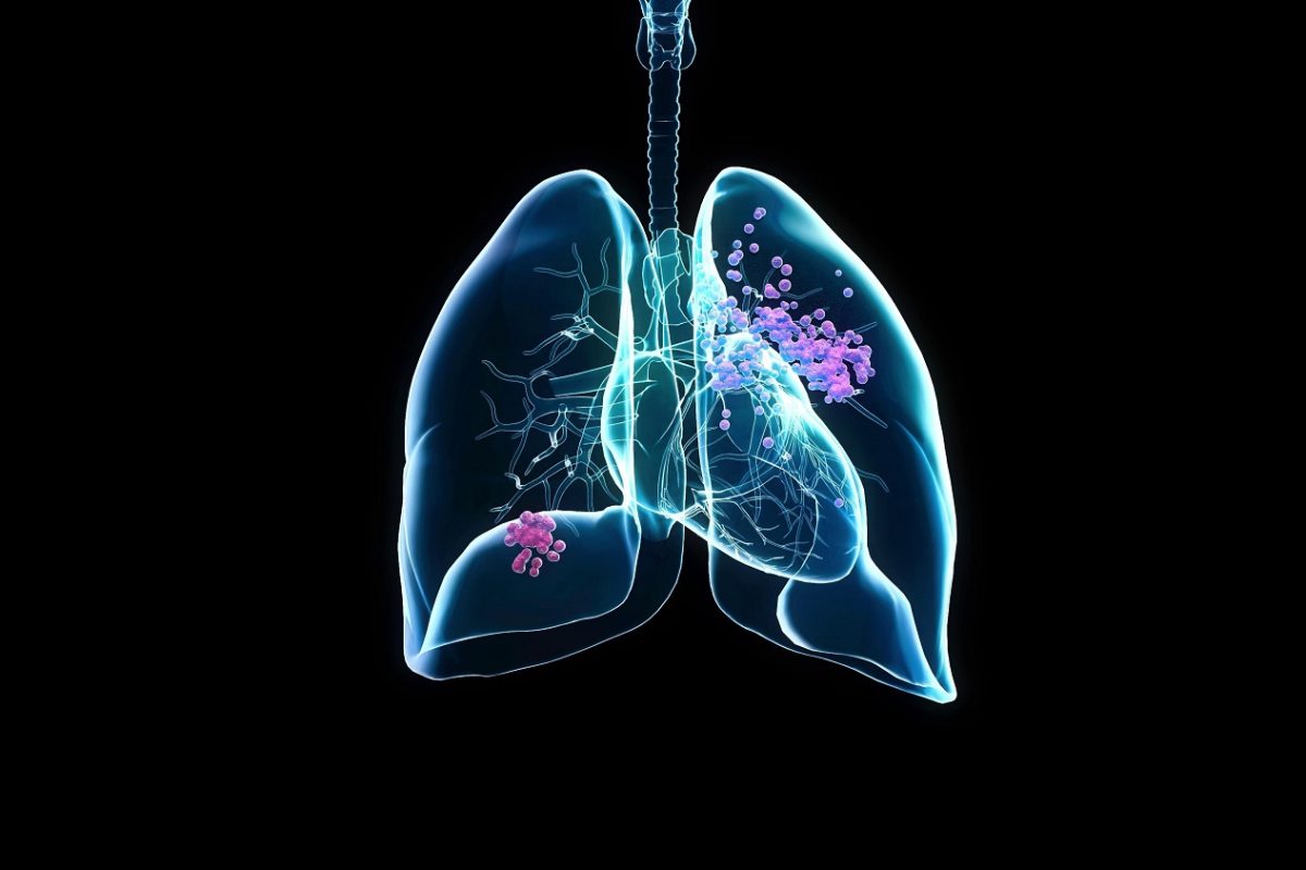 Jön az új fegyver a tüdőrák elleni küzdelemben